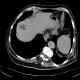Abscess in liver, cholangoitis, maturation, first CT: CT - Computed tomography
